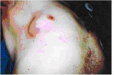 سرطان الثدي بين الرجال في الأردن ..حقيقة مغفلة