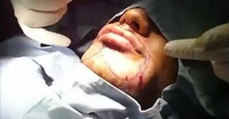 رجال يزاحمون النساء في عمليات نفخ الشفايف..فيديو