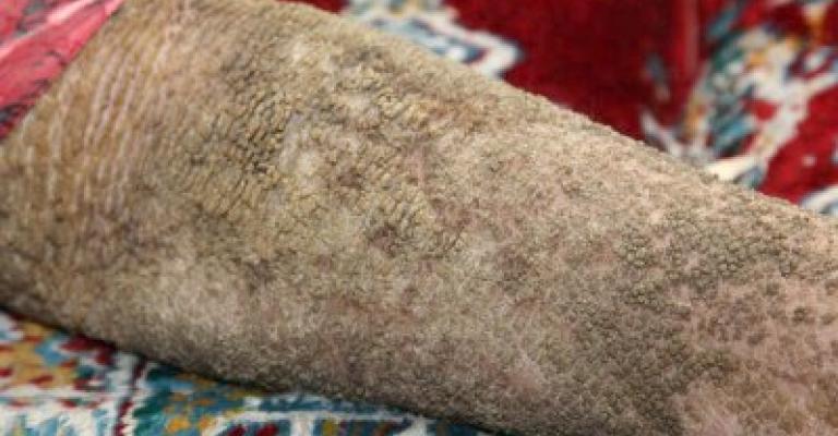 الحراشف تغطي جسد فتاة اردنية 