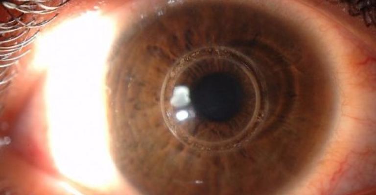 التبرع بالقرنية المخروطية يعيد لروان وروز نعمة النظر