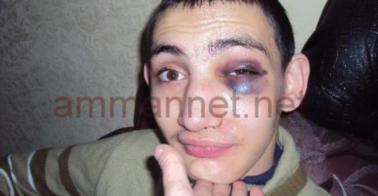 طفل معاق ضحية للانتهاكات في مراكز الرعاية- عدسة حنان خندقجي 