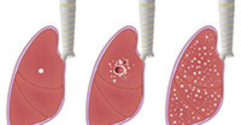 اصابات بمرض السل تعبر الحدود الى الاردن 