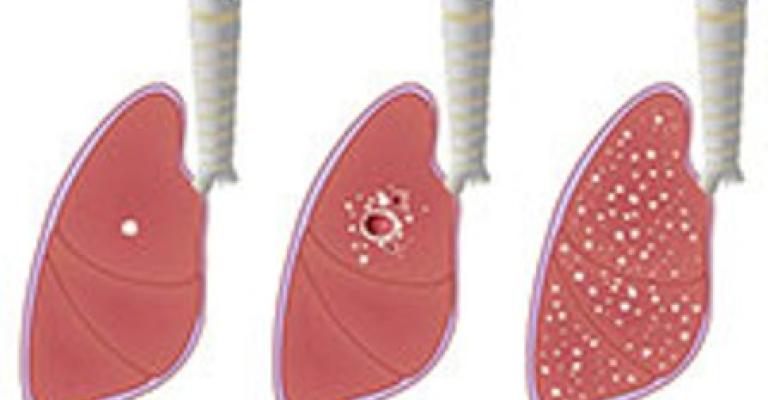 20 إصابة ب"السل" لكل 100 ألف من اللاجئين السوريين 