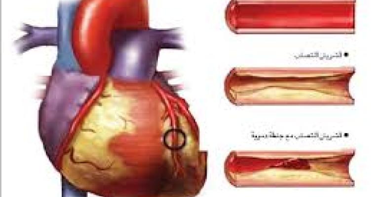 عوامل الخطر للإصابة بتصلب الشرايين
