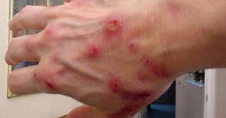 الصحة تتابع 226 حالة جرب بحكما