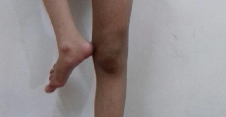 حالة صعبة لطفل أردني ولد بلا فخذ حالة صعبة لطفل أردني ولد بلا فخذ