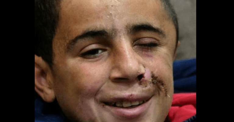 الطفل التميمي : الرصاصة برأسي والمقاومة بقلبي