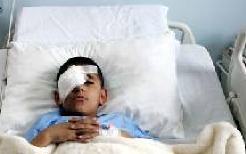 استئصال عين الطالب الدويكات