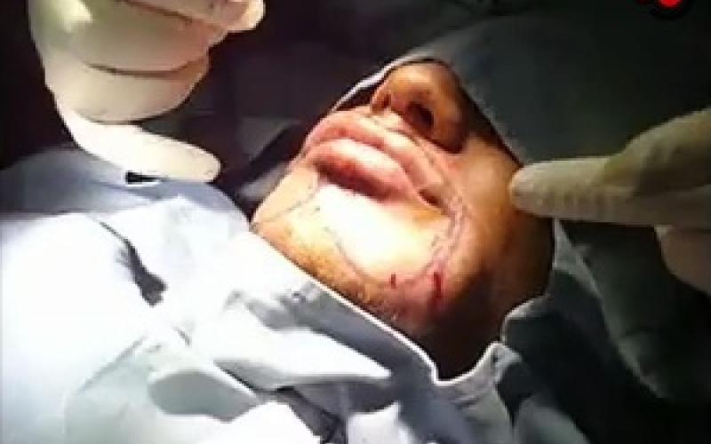 رجال يزاحمون النساء في عمليات نفخ الشفايف..فيديو