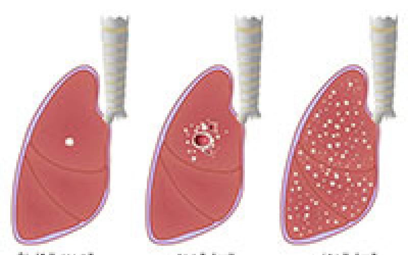 اصابات بمرض السل تعبر الحدود الى الاردن 