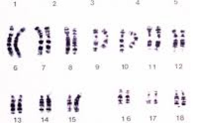 اليوم الوطني لمتلازمة داون .. تحت شعار (منقدر)