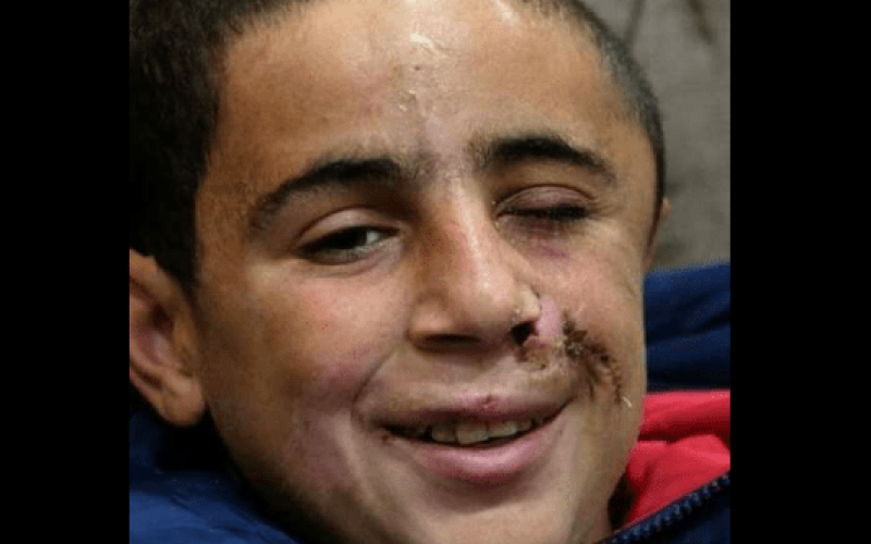 الطفل التميمي : الرصاصة برأسي والمقاومة بقلبي